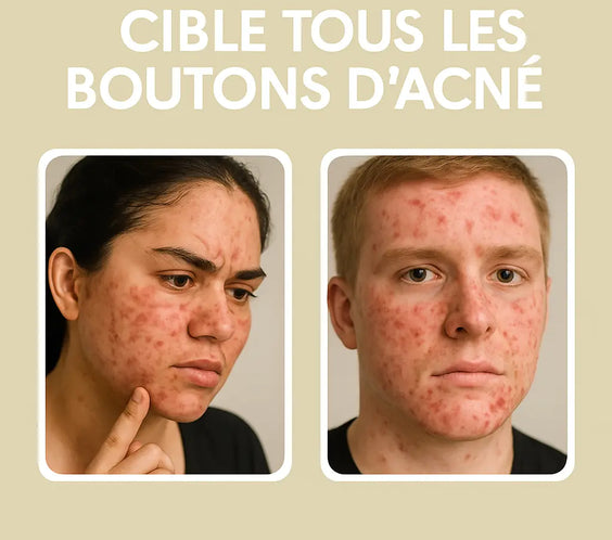 Coffret Premium                                360 Patchs Anti-Acné Purifiants