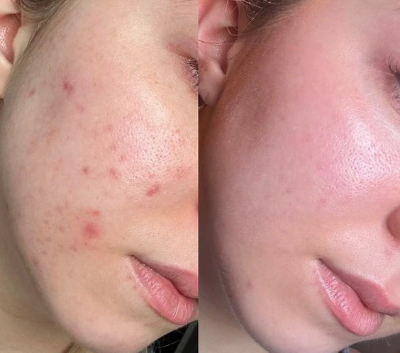 Crème Coréenne Anti-Acné Bio Action Rapide, Peau Lisse & Bestseller TikTok