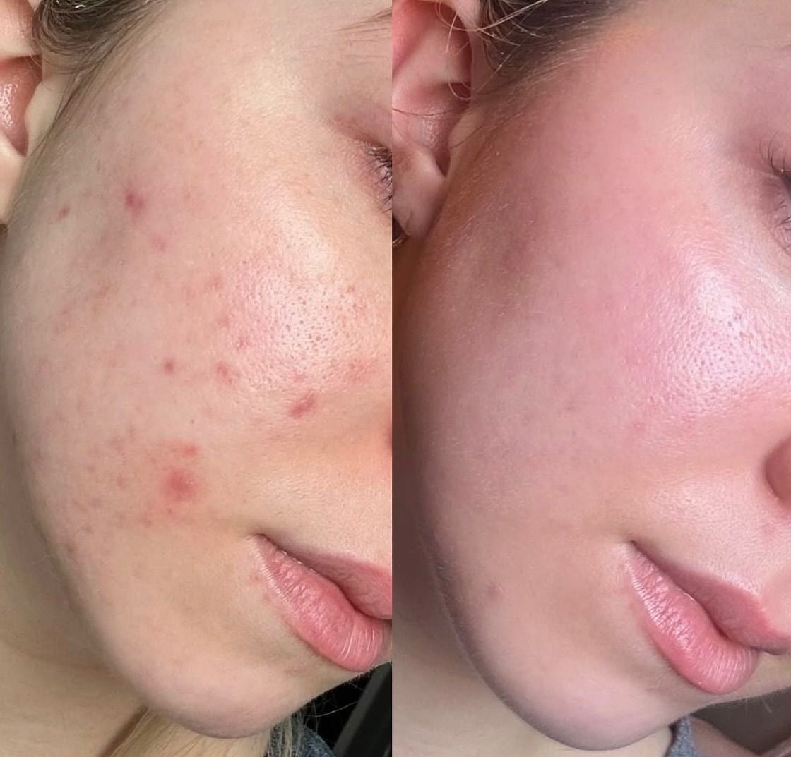 Crème Coréenne Anti-Acné Bio Action Rapide, Peau Lisse & Bestseller TikTok